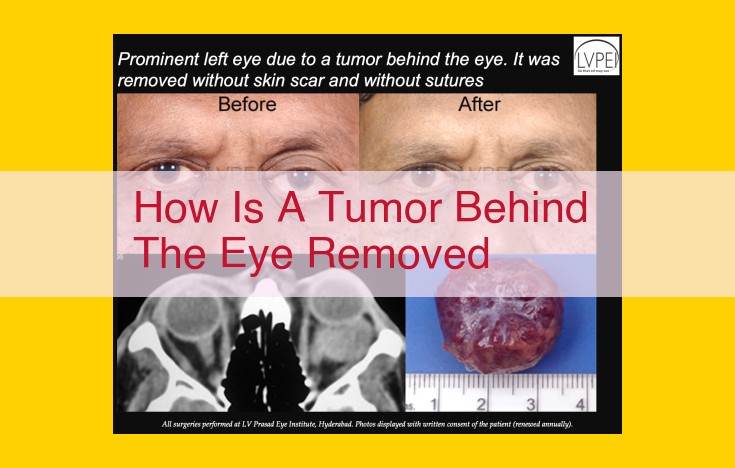 Removal of Tumors Behind the Eye: Surgical Approaches, Imaging Guidance, and Medical Expertise