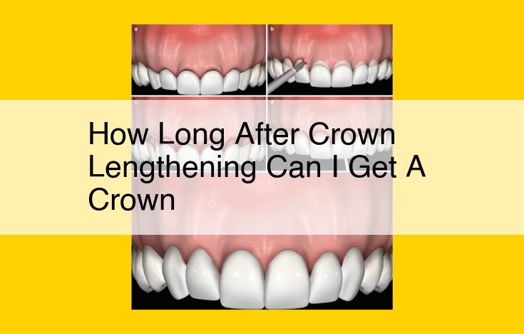 6-8 Weeks to Wait for Crown Placement After Crown Lengthening: A Comprehensive Guide