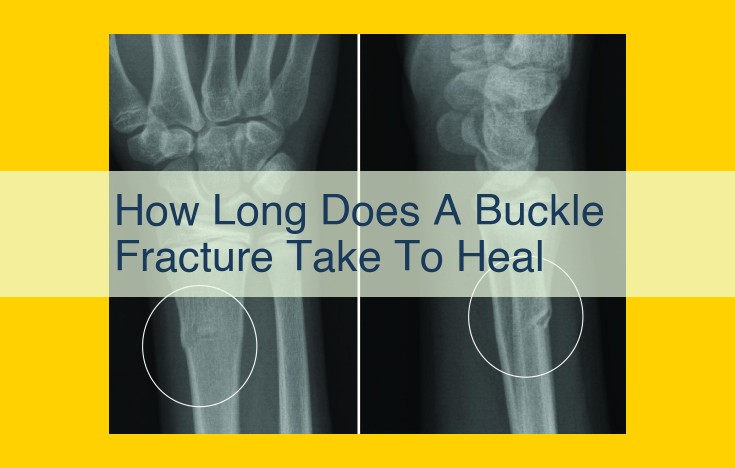 Buckle Fractures: 4-6 Week Healing, Immobilization Essential for Bone Restoration