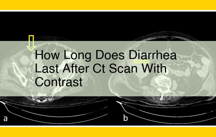 Diarrhea After CT Scan with Contrast: Duration, Causes, and Management