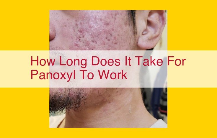 Panoxyl Acne Treatment: Timeline for Results and Tips for Best Outcomes