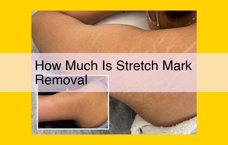 Comprehensive Guide to Stretch Mark Removal Costs: Treatment Options and Medical Specialties