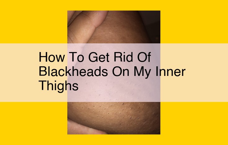 Ultimate Guide: Effective Blackhead Removal on Inner Thighs