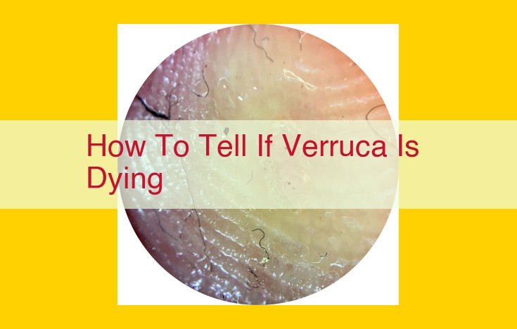 Signs of a Dying Verruca: A Guide to Healing and Relief