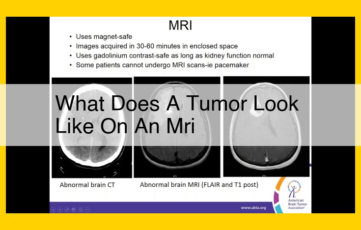 Identifying and Characterizing Brain Tumors on MRI: Essential Insights for Radiologists