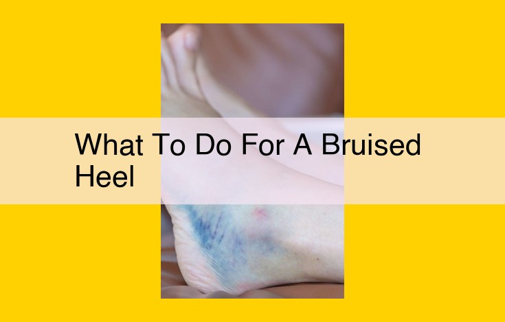 Bruised Heel: Comprehensive Guide to Treatment and Prevention